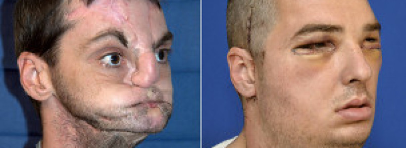 transplante_de_rostro_extraordinario