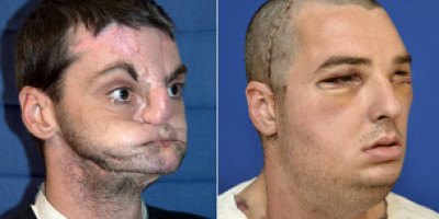 transplante_de_rostro_extraordinario