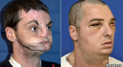 transplante_de_rostro_extraordinario