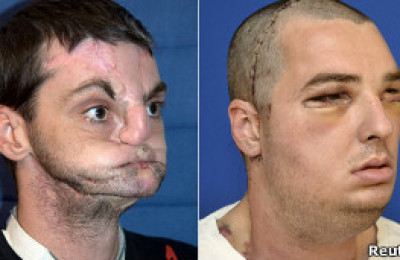 transplante_de_rostro_extraordinario