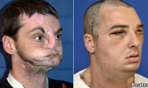 transplante_de_rostro_extraordinario