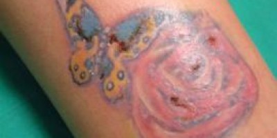 Riesgos-de-hacerse-un-tatuaje