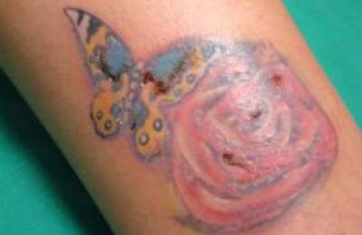 Riesgos-de-hacerse-un-tatuaje
