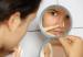 acne_6797665788998645