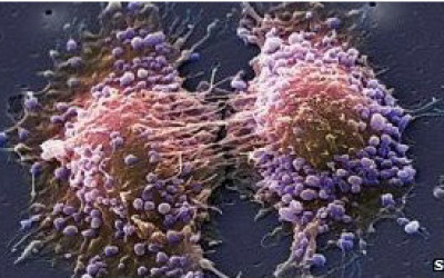 120417084728_prostate_cancer_304x171_spl_nocredit