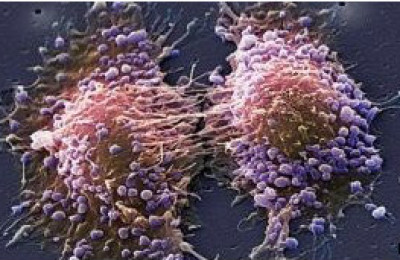 120417084728_prostate_cancer_304x171_spl_nocredit