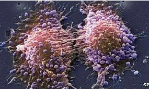 120417084728_prostate_cancer_304x171_spl_nocredit