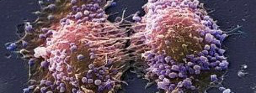 120417084728_prostate_cancer_304x171_spl_nocredit