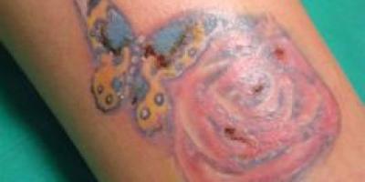 Riesgos-de-hacerse-un-tatuaje
