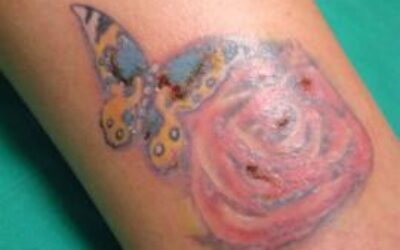 Riesgos-de-hacerse-un-tatuaje