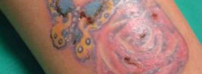 Riesgos-de-hacerse-un-tatuaje