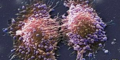 prostata_cancer5674574