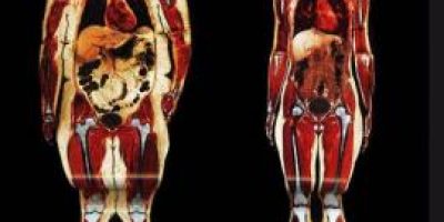 As-nos-afecta-la-obesidad