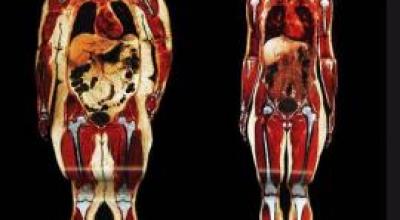 As-nos-afecta-la-obesidad