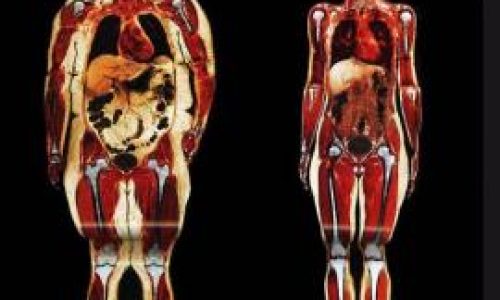 As-nos-afecta-la-obesidad