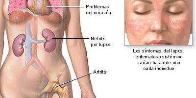 lupus_01765967