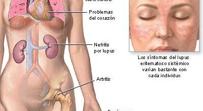 lupus_01765967