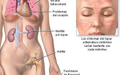 lupus_01765967