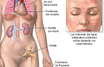 lupus_01765967