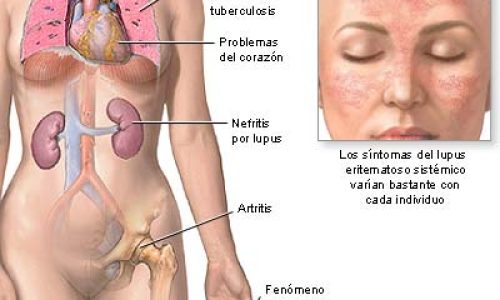 lupus_01765967