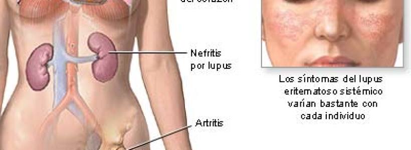 lupus_01765967