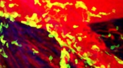Un-infarto-300x173