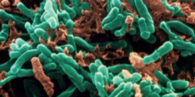 tuberculosis97786744657