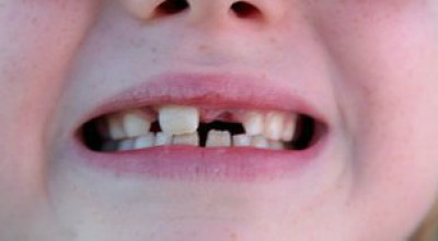 120903092337_caries_304x171_spl_nocredit