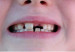 120903092337_caries_304x171_spl_nocredit