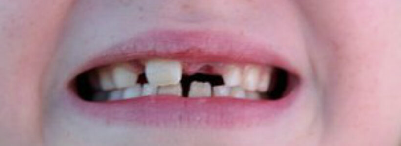 120903092337_caries_304x171_spl_nocredit