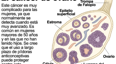 cancer-de-ovario