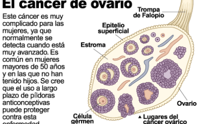 cancer-de-ovario