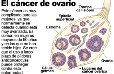 cancer-de-ovario