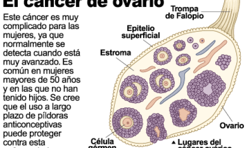 cancer-de-ovario