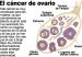 cancer-de-ovario