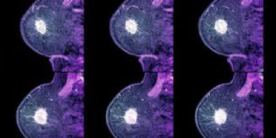 cancer_mama-4tipos