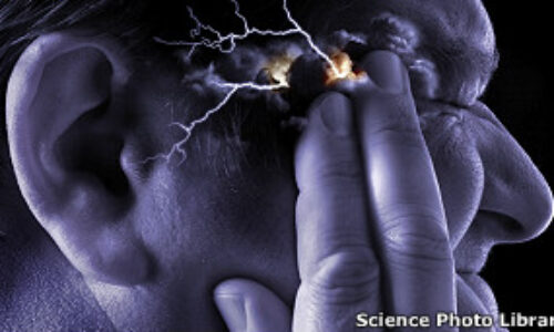 30212152746_migraine_supraorbital_transcutaneous_stimulator_304x171_sciencephotolibrary
