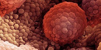 130304113701_prostata_304x171_spl