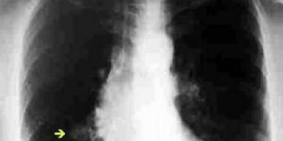 nodulo-pulmonar