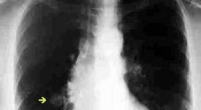 nodulo-pulmonar