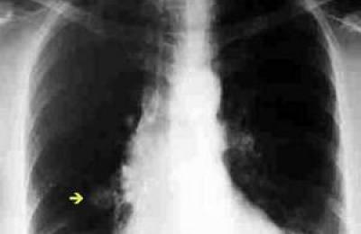 nodulo-pulmonar