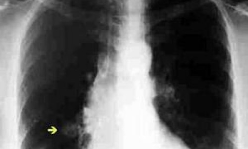 nodulo-pulmonar