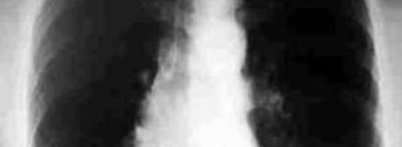 nodulo-pulmonar