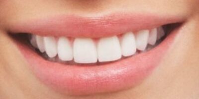 Dientes-blancos--300x192