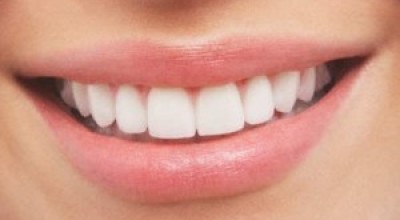 Dientes-blancos--300x192