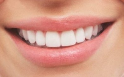 Dientes-blancos--300x192