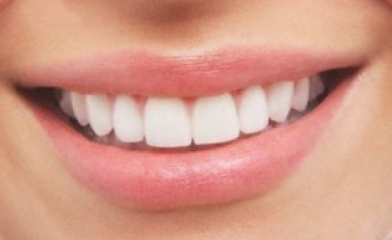 Dientes-blancos--300x192