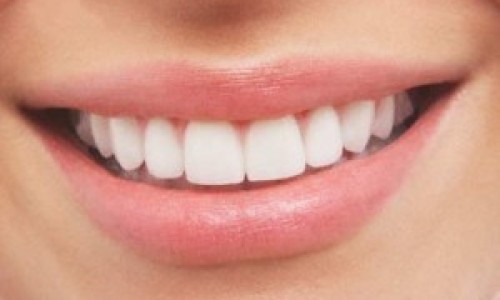 Dientes-blancos--300x192