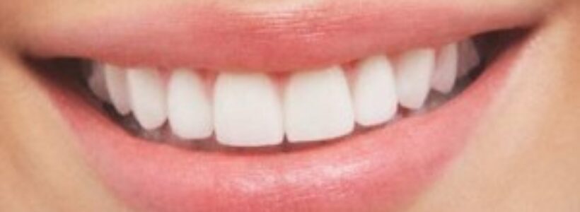 Dientes-blancos--300x192