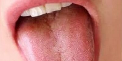 boca-lengua-300x192